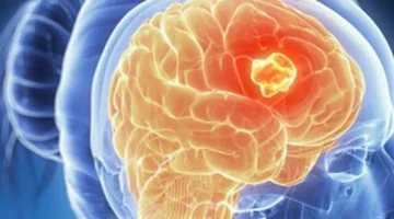 التنبؤ بشراسة الورم السرطاني يحدد مسار انتشار المرض بدقة باستخدام الذكاء الاصطناعي 1